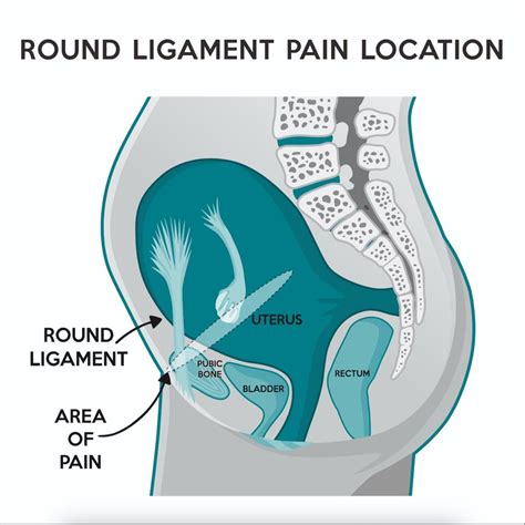 round ligament ağrısı